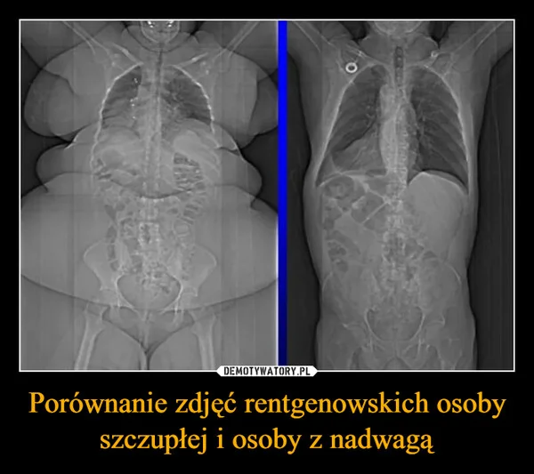 
    Porównanie zdjęć rentgenowskich osoby szczupłej i osoby z nadwagą