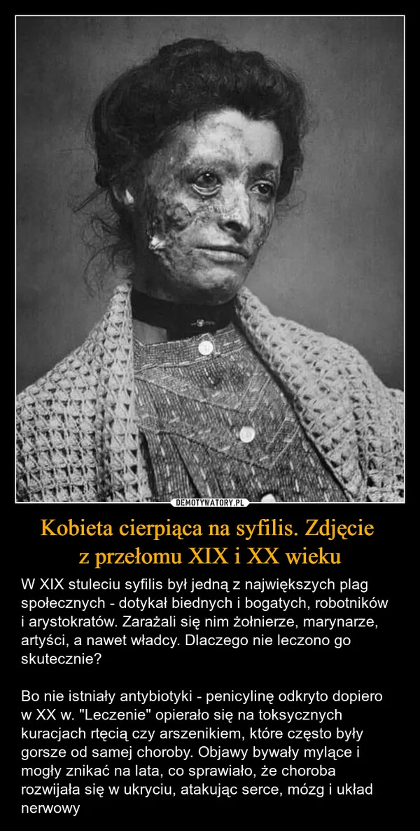 
    Kobieta cierpiąca na syfilis. Zdjęcie z przełomu XIX i XX wieku