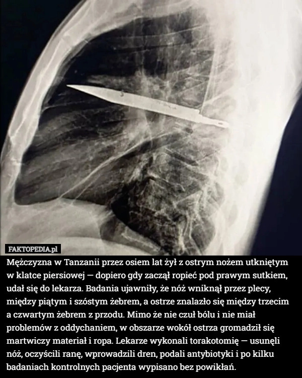 
    Mężczyzna w Tanzanii przez osiem lat żył z ostrym nożem utkniętym w klatce