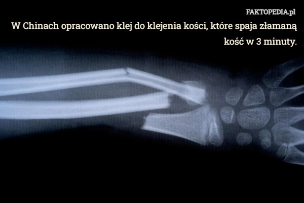 
    W Chinach opracowano klej do klejenia kości, które spaja złamaną kość w