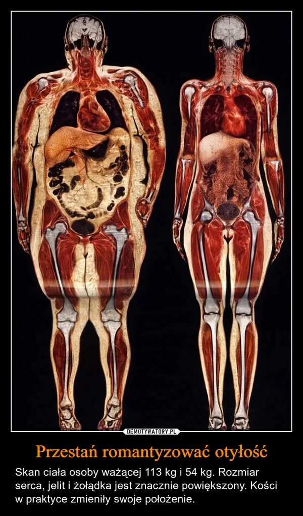 Przestań romantyzować otyłość