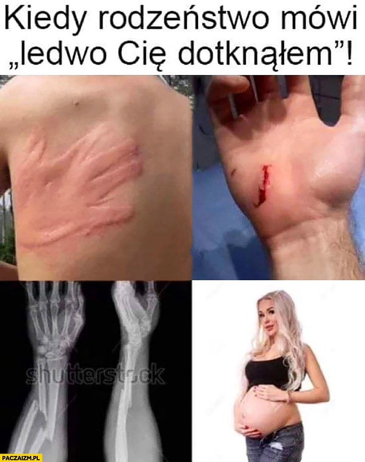 Kiedy rodzeństwo mówi ledwo Cię dotknąłem złamanie ciąża