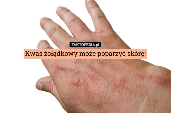 
    Kwas żołądkowy może poparzyć skórę!