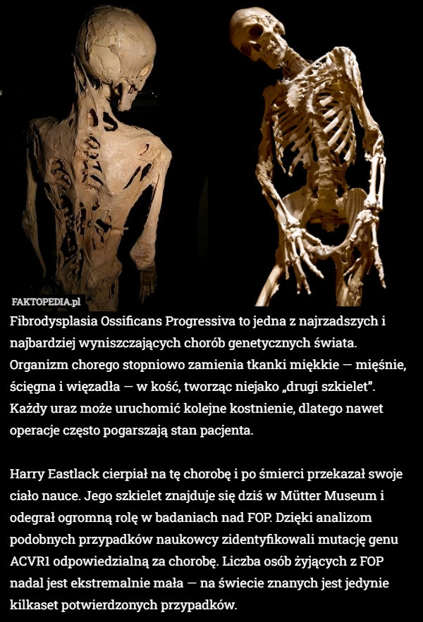 
    Fibrodysplasia Ossificans Progressiva to jedna z najrzadszych i najbardziej