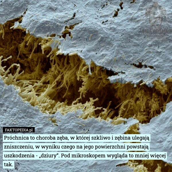 
    Próchnica to choroba zęba, w której szkliwo i zębina ulegają zniszczeniu,